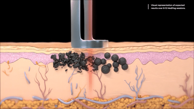 Animated illustration of an Nd:Yag laser device removing pigment or ink from skin.