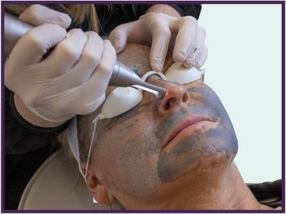 Photo of a woman receiving a carbon facial treatment from the MediYag by Medicreations.