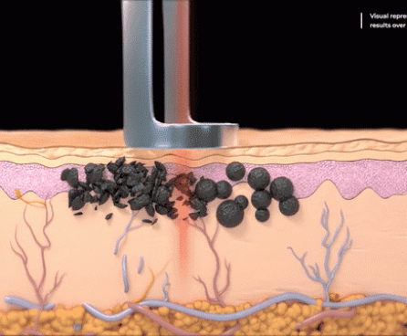 Animated illustration of an Nd:Yag laser device removing pigment or ink from skin.