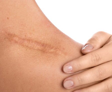 scar and stretch mark treatment
